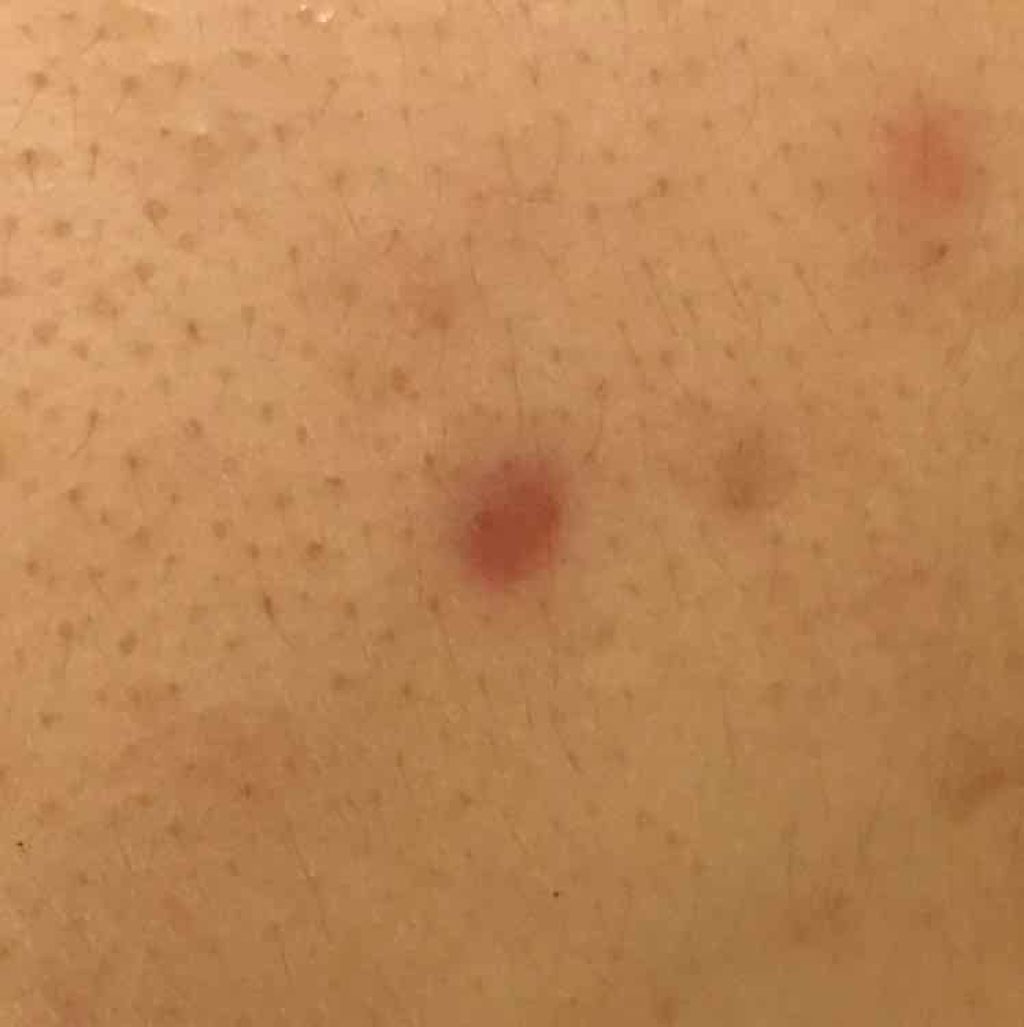 薬用 しみ 集中対策 美容液/メラノCC/美容液を使ったクチコミ(2枚目)