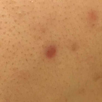 薬用 しみ 集中対策 美容液/メラノCC/美容液を使ったクチコミ(2枚目)