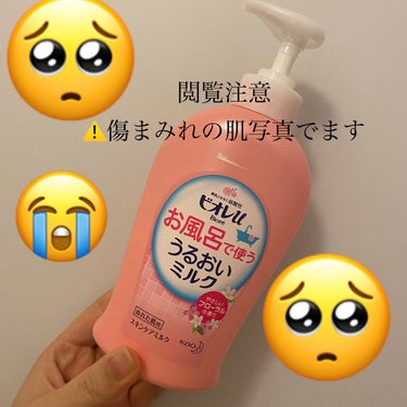 記録用で、、、😭
肌の写真でます！閲覧注意です！！！！ぶつぶつです！！！！気持ち悪いです！！！！

とにかく乾燥肌のわたしは、皮膚科にもお世話になっているほど肌が弱め、、、
化粧品等で荒れたことはないの