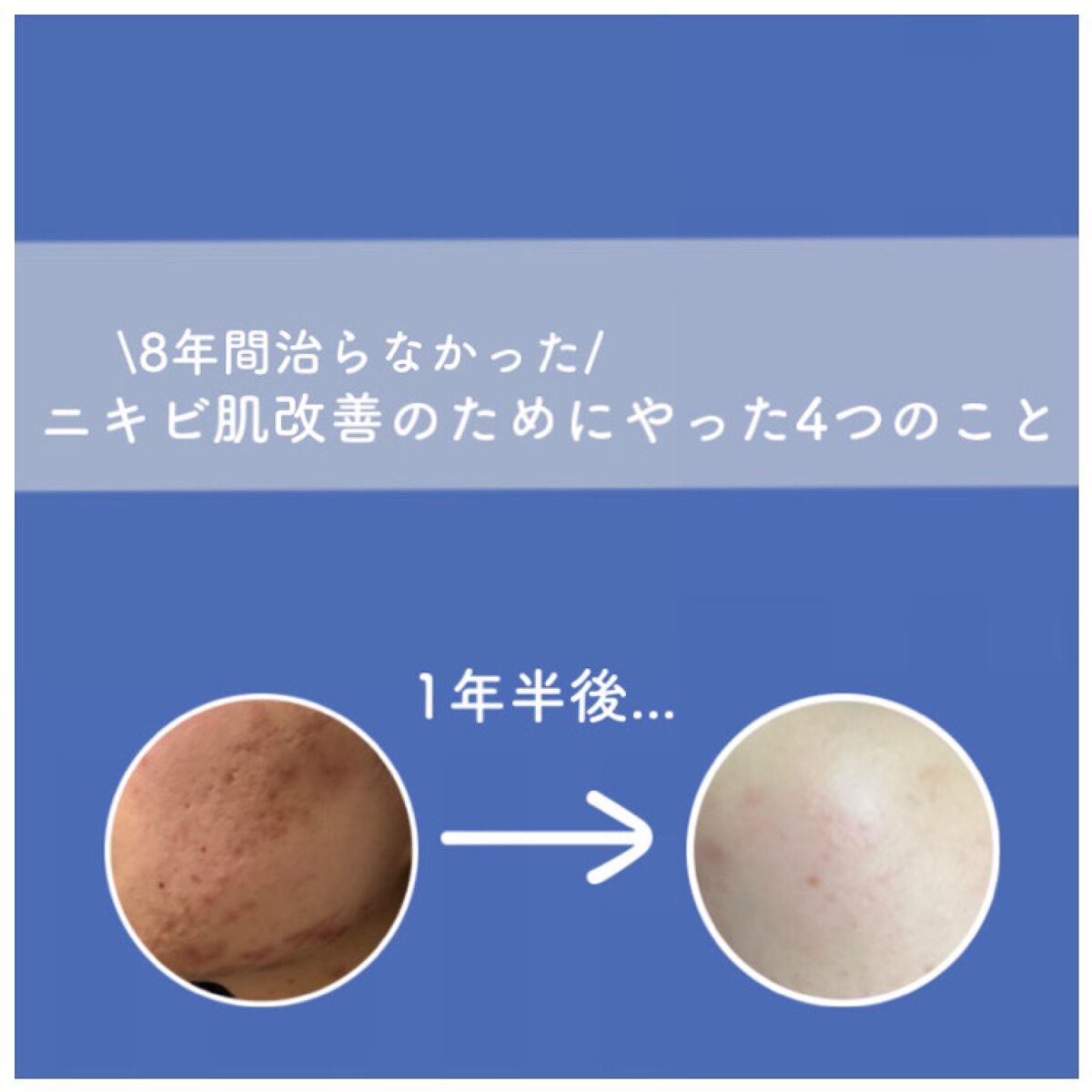 PaL❄️ on LIPS 「【ニキビを無くしたい方へ🔥】はじめてPeLです!!今回はニキビ..」(1枚目)