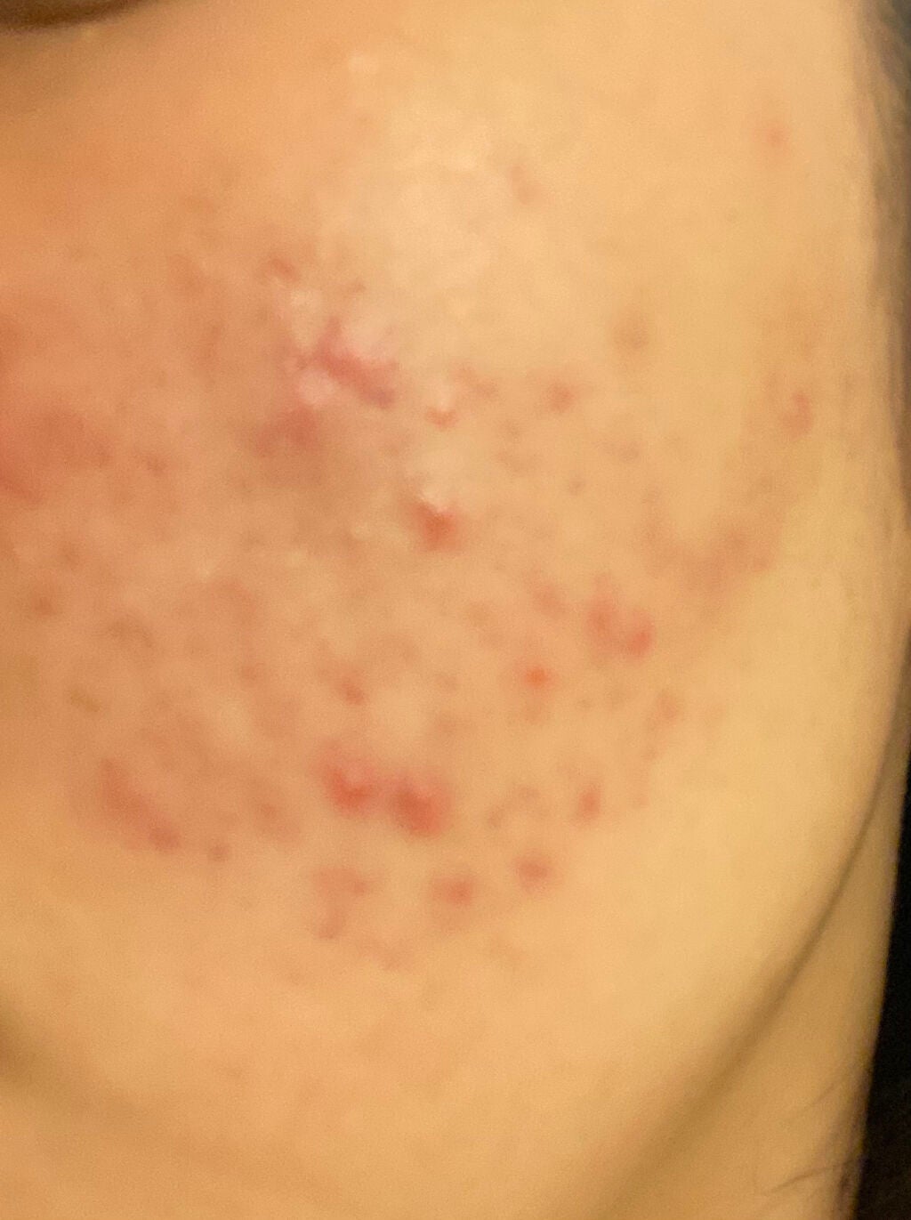 オロナインH軟膏 (医薬品)/オロナイン/その他を使ったクチコミ(2枚目)