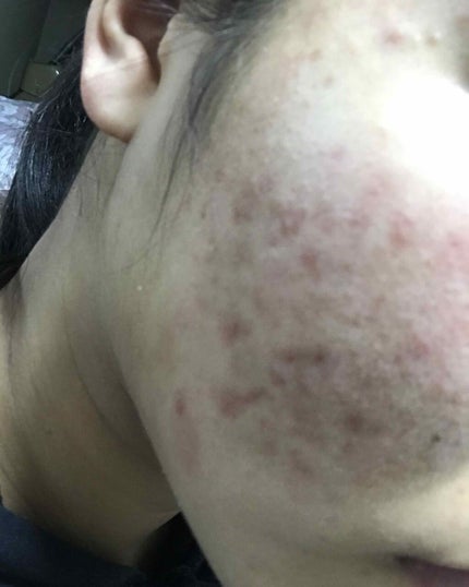 薬用 しみ 集中対策 美容液/メラノCC/美容液を使ったクチコミ(1枚目)