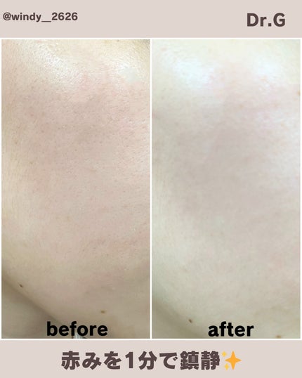 レッドブレミッシュクイックPHAシートマスク/Dr.G/シートマスク・パックを使ったクチコミ(4枚目)