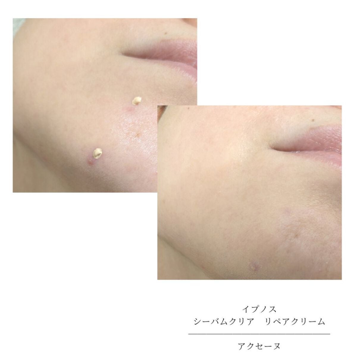 イプノス シーバムクリア リペアクリーム/ACSEINE/フェイスクリームを使ったクチコミ(7枚目)