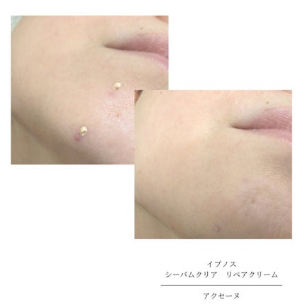 イプノス シーバムクリア リペアクリーム/ACSEINE/フェイスクリームを使ったクチコミ(7枚目)
