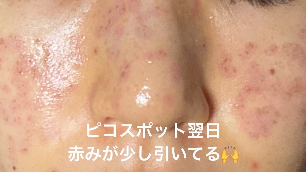 ダイブイン セラム/Torriden/美容液を使ったクチコミ(4枚目)