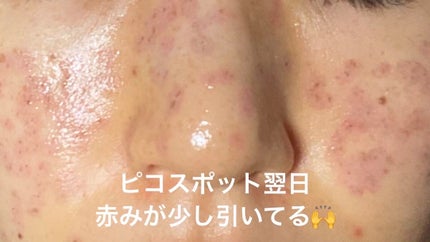 ダイブイン セラム/Torriden/美容液を使ったクチコミ(4枚目)