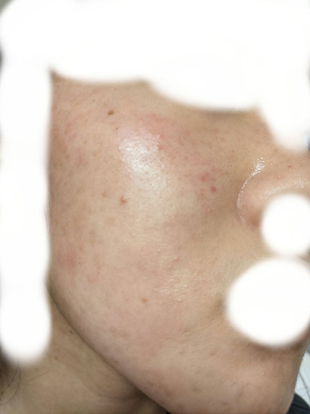 いやりんぐ on LIPS 「皮膚科の薬副反応が出るかもって聞いて少し怖かったんですけど、少..」(3枚目)