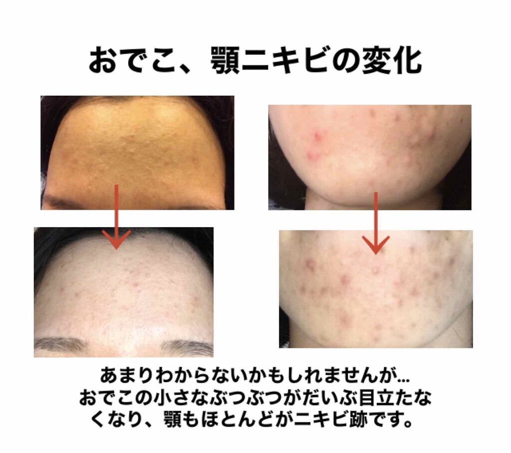 Ⅲ トライアルセット/NOV/トライアルキットを使ったクチコミ(3枚目)
