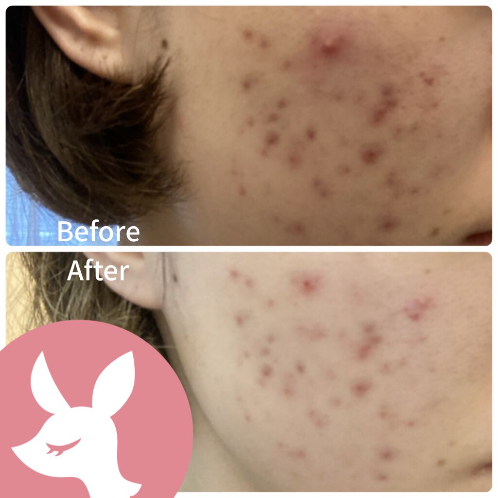 REJURAN ターンオーバーアンプル 30ml/REJURAN COSMETICS/美容液を使ったクチコミ（3枚目）