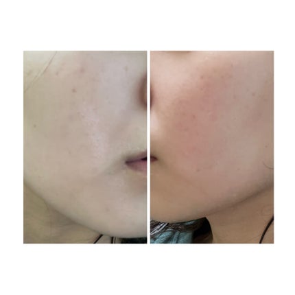 ぽむ on LIPS 「2023.9.13皮膚科に受診 エピデュオとヘパリン処方1枚目..」(3枚目)