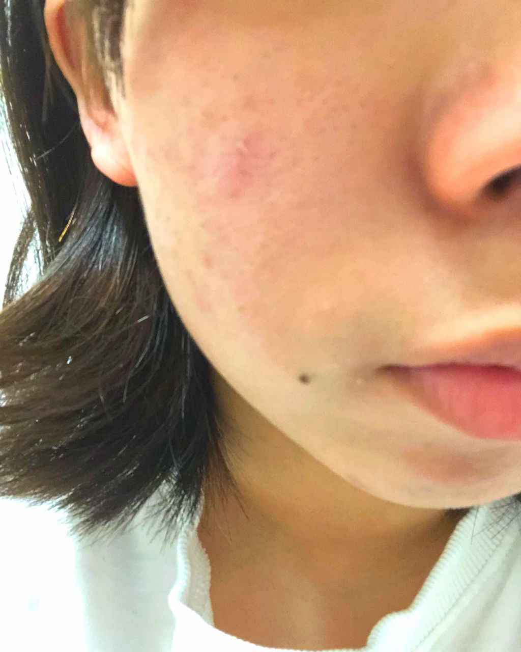 バイオイル/バイオイル/フェイスオイルを使ったクチコミ（2枚目）