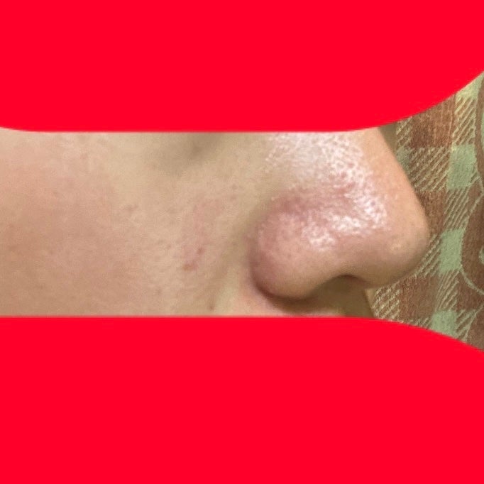 エビ on LIPS 「初めまして!助けてください!この鼻のブツブツとザラザラと毛穴が..」(2枚目)