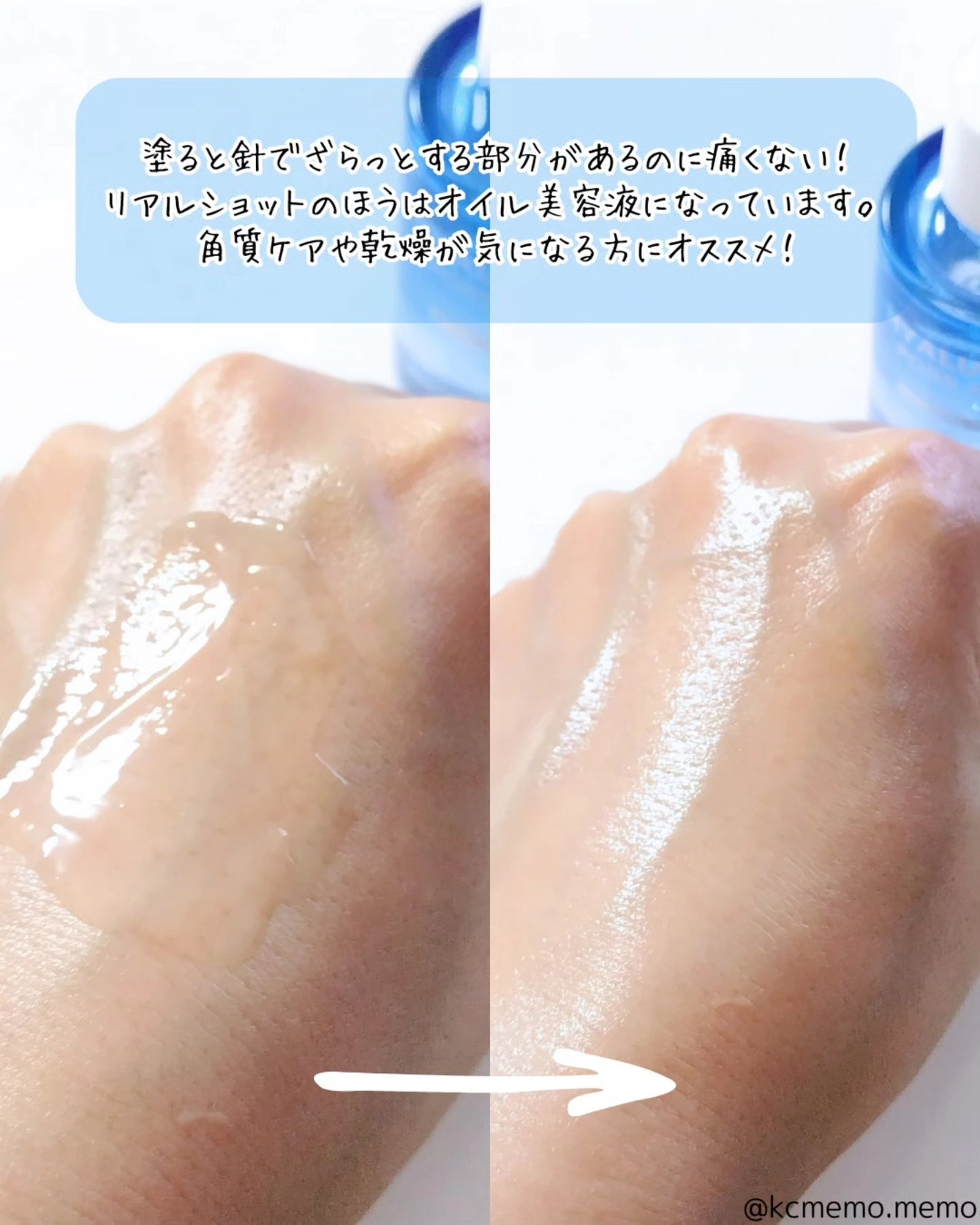 メモ魔ちゃん@韓国コスメメモ日記 on LIPS 「韓国初の見えるヒアルロン酸ニードル!本日のメモ✍️Snp♡コレ..」(6枚目)