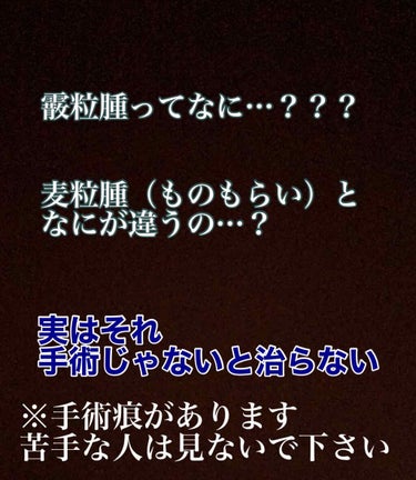 

⚠️目に手術痕があります
　　苦手な方は見ないことをおすすめします
　　　とても長い手術レポです



８月の初めの頃でした

突然眼にできものができました。

元から、ものもらいがなりやすい方なの