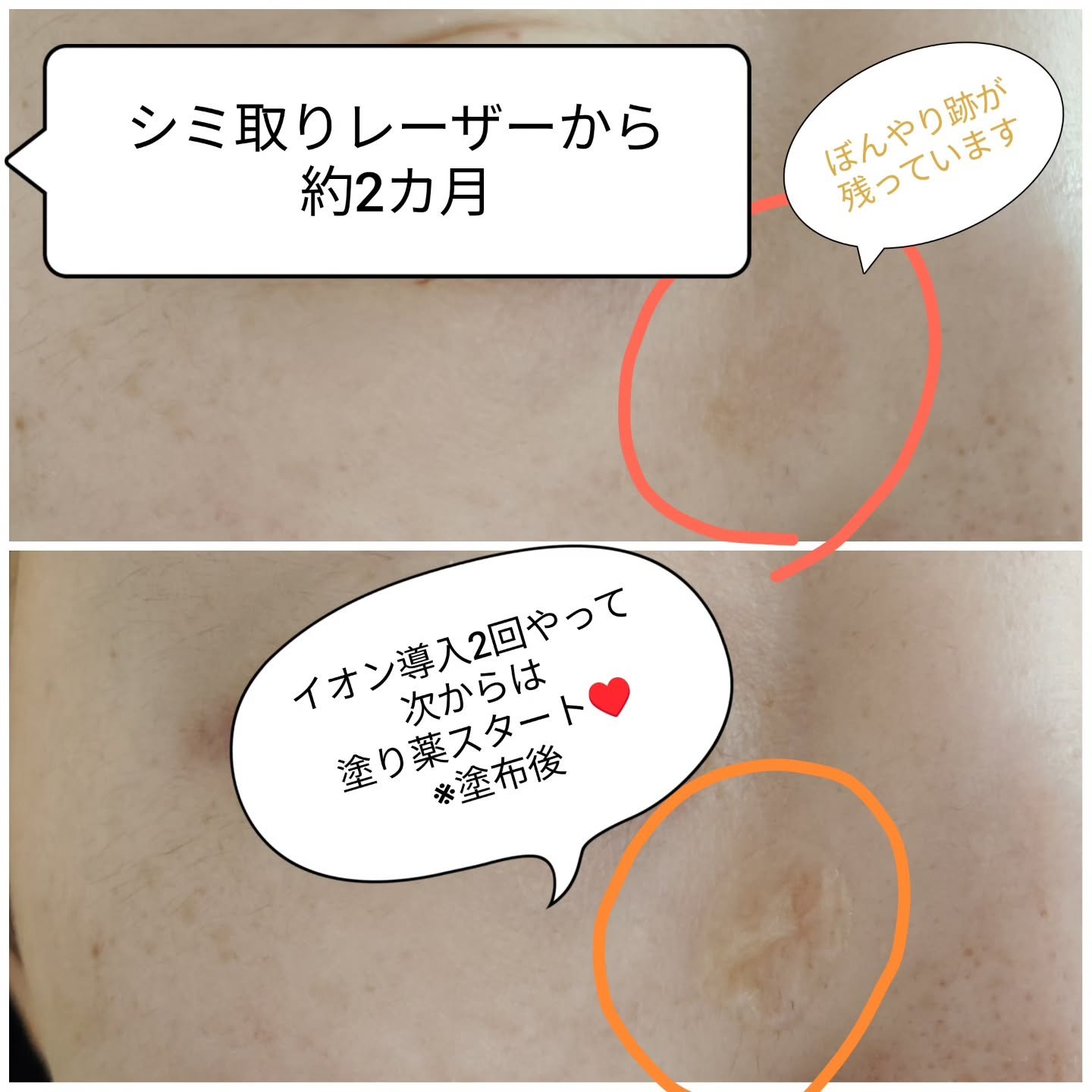 トラネキサム酸　250mg/東和薬品/その他を使ったクチコミ（2枚目）