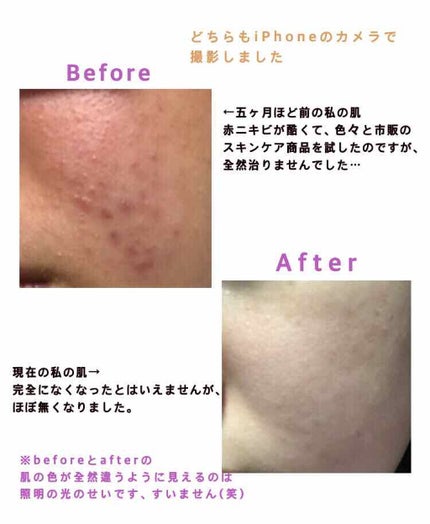 ビーソフテン ローション(医薬品)/持田製薬/その他を使ったクチコミ(2枚目)