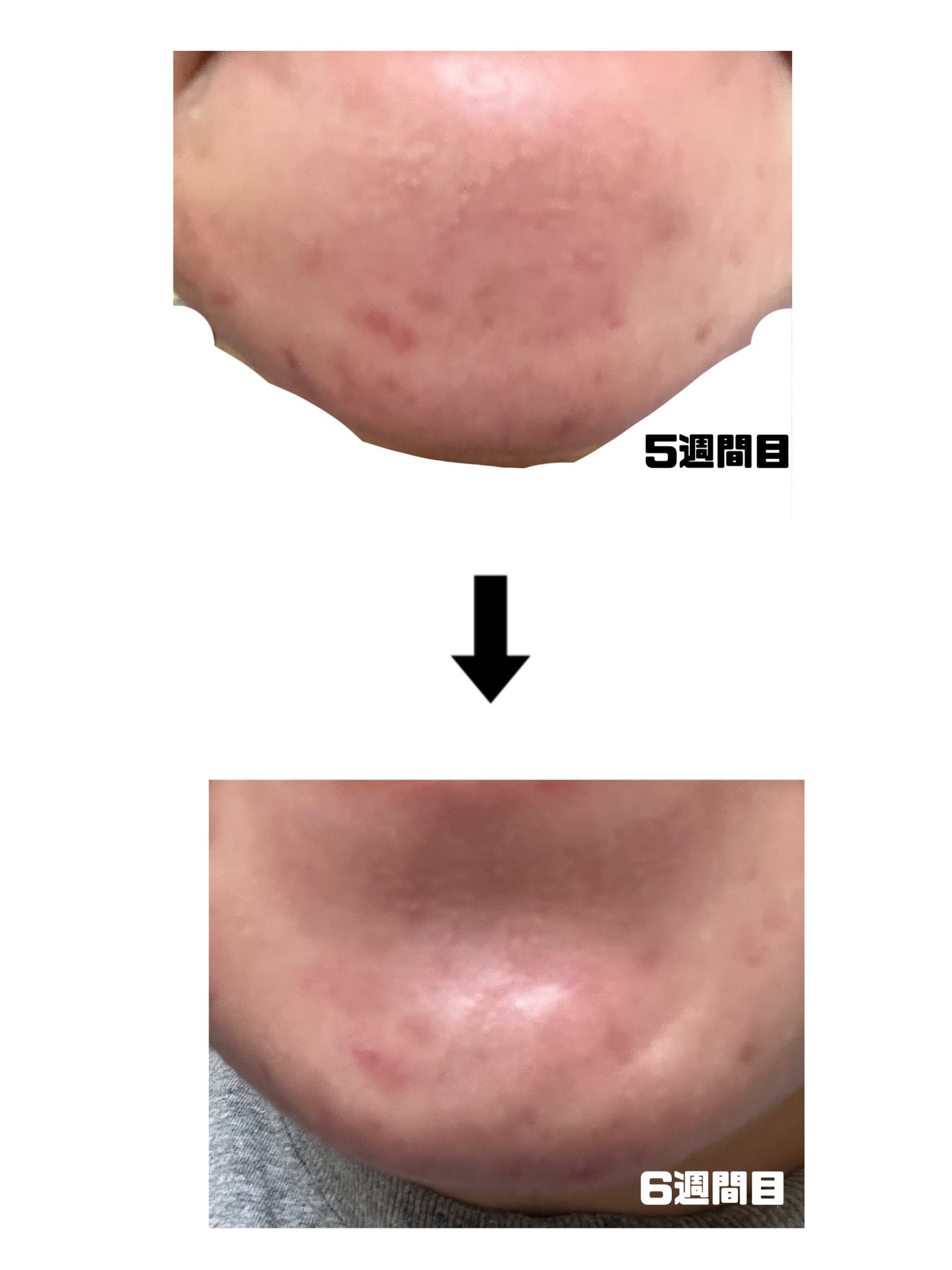 みこ on LIPS 「【ニキビ治療経過記録】閲覧注意です!!エピデュオゲルとその他も..」(4枚目)