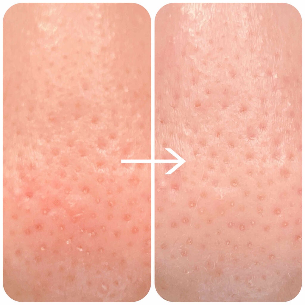 ベーキングパウダー クランチポア スクラブ/ETUDE/スクラブ・ゴマージュを使ったクチコミ(2枚目)