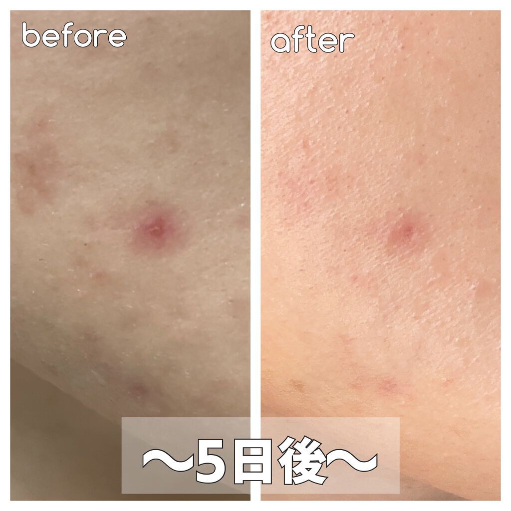 バルンソンリペアキット/SKINSBIBLE/その他スキンケアを使ったクチコミ（3枚目）