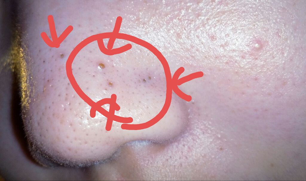 すみれ on LIPS 「助けてください、、、写真を見てわかるように毛穴が本当に酷いんで..」(3枚目)