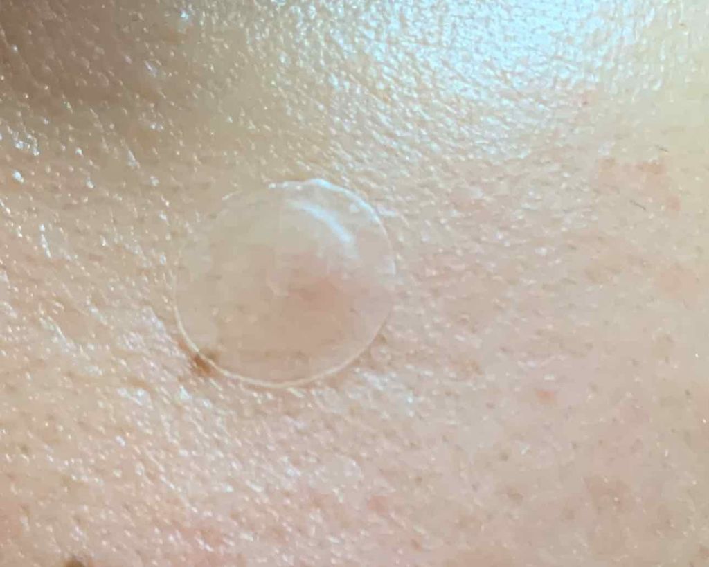 ゼロスポットパッチ/Today’s Cosme/にきびパッチを使ったクチコミ（3枚目）