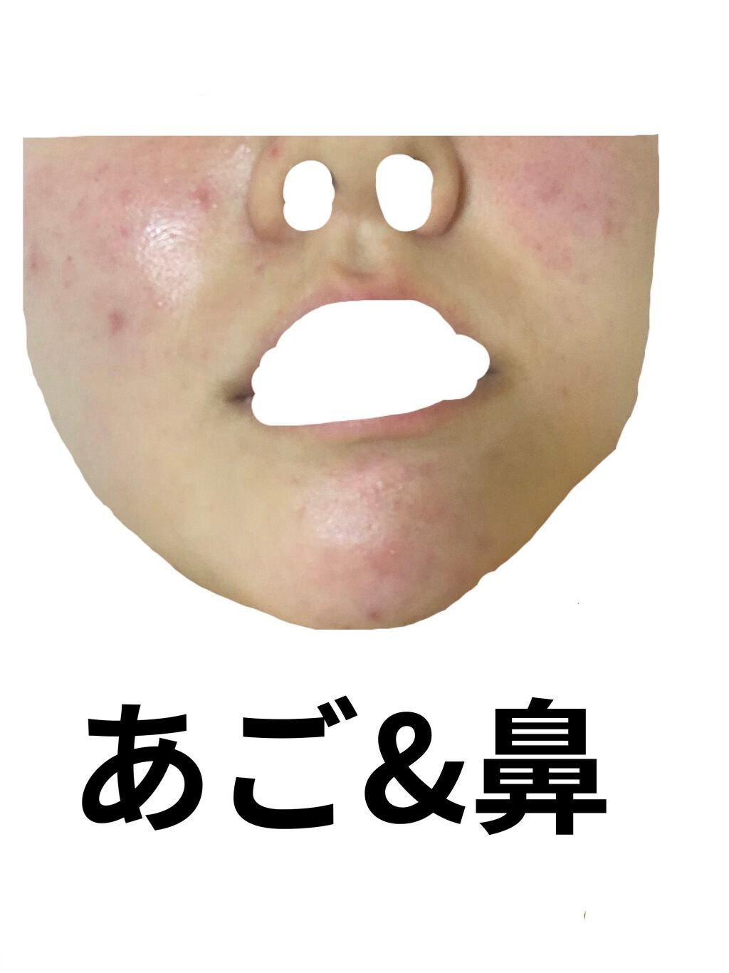 きなこもち on LIPS 「お願いします。私と同じようなニキビの方治し方を教えて欲しいです..」(4枚目)