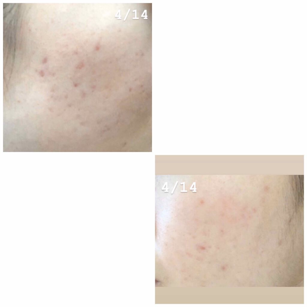 ノブ A アクネソープ/NOV/洗顔石鹸を使ったクチコミ(3枚目)