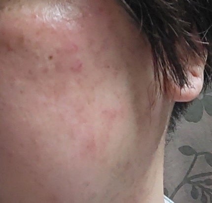 アゼライン酸15 インテンスカーミングセラム/Anua/美容液を使ったクチコミ(2枚目)