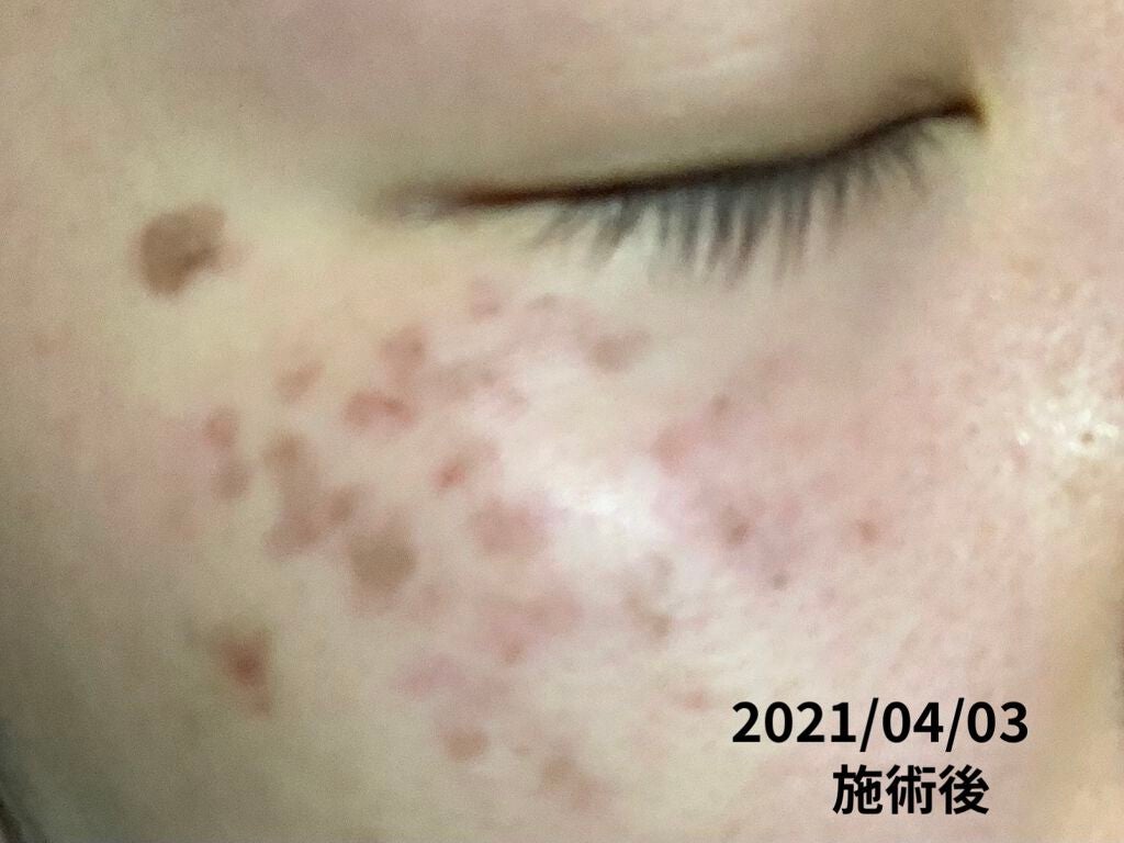 ã¡ããðŠãã©ãã100 on LIPS ãâïž----ã·ãåãã¬ãŒã¶ãŒã«ã€ããŠ----â ïž2æç®é²èŠ§æ³šæ..ãïŒ2æç®ïŒ