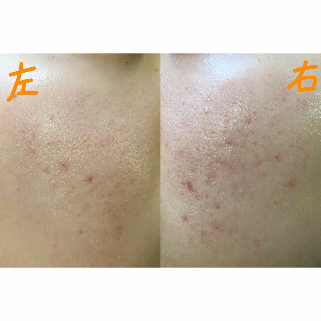 ハトムギ化粧水(ナチュリエ スキンコンディショナー R )/ナチュリエ/化粧水を使ったクチコミ（3枚目）