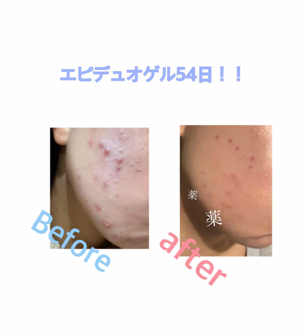 エピデュオゲル/マルホ株式会社/その他を使ったクチコミ（1枚目）