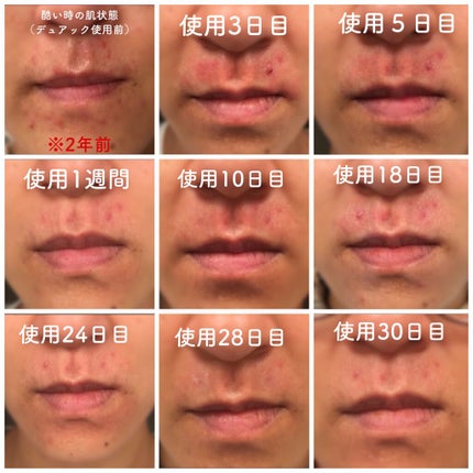 オードムーゲ 薬用ローション(ふきとり化粧水)/オードムーゲ/拭き取り化粧水を使ったクチコミ(2枚目)