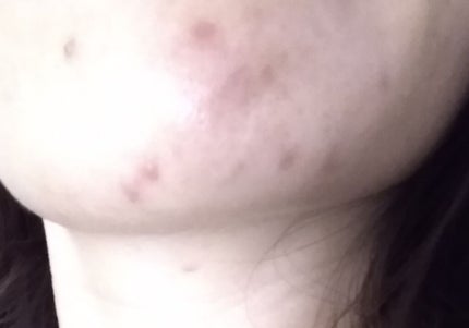 クリアモイスチャー L(さっぱりタイプ)/オルビス/乳液を使ったクチコミ(2枚目)