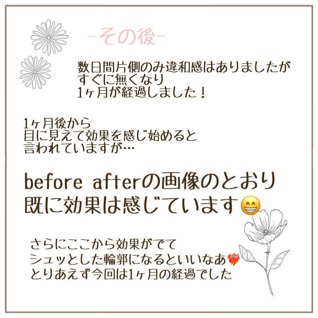 sayu on LIPS 「ずっとずっとやりたかったエラボトックス受けて来ました💓今回私は..」(7枚目)