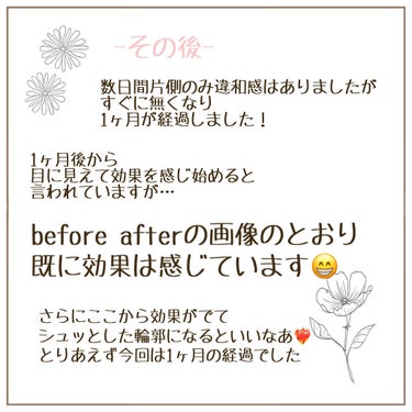 sayu on LIPS 「ずっとずっとやりたかったエラボトックス受けて来ました💓今回私は..」（7枚目）