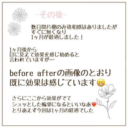 sayu on LIPS 「ずっとずっとやりたかったエラボトックス受けて来ました💓今回私は..」(7枚目)