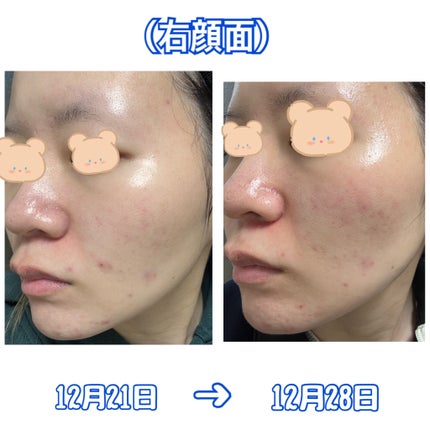 レチノール0.3 ナイアシンリニューイングセラム/Anua/美容液を使ったクチコミ(4枚目)