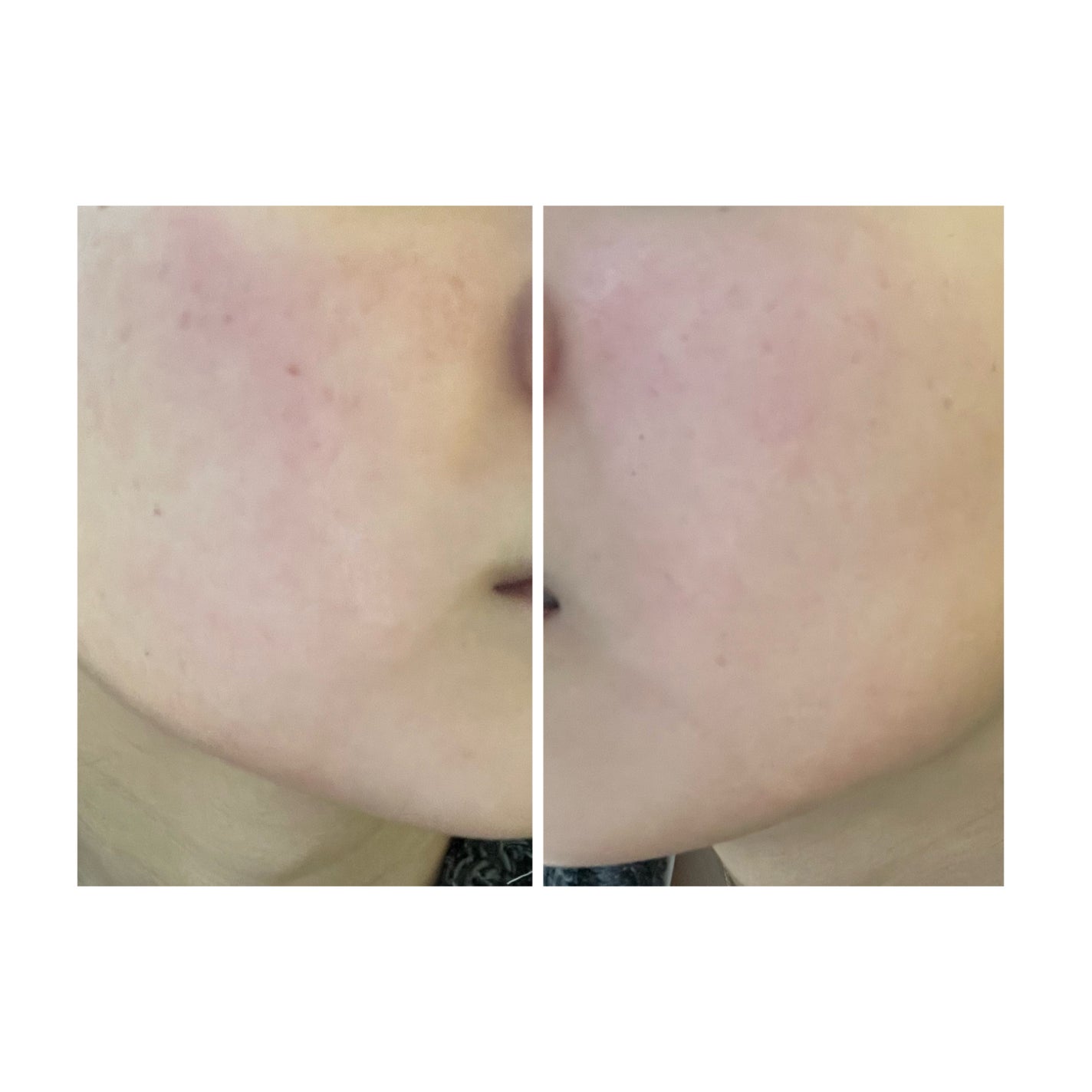 ぽむ on LIPS 「2023.9.13皮膚科に受診 エピデュオとヘパリン処方1枚目..」(5枚目)