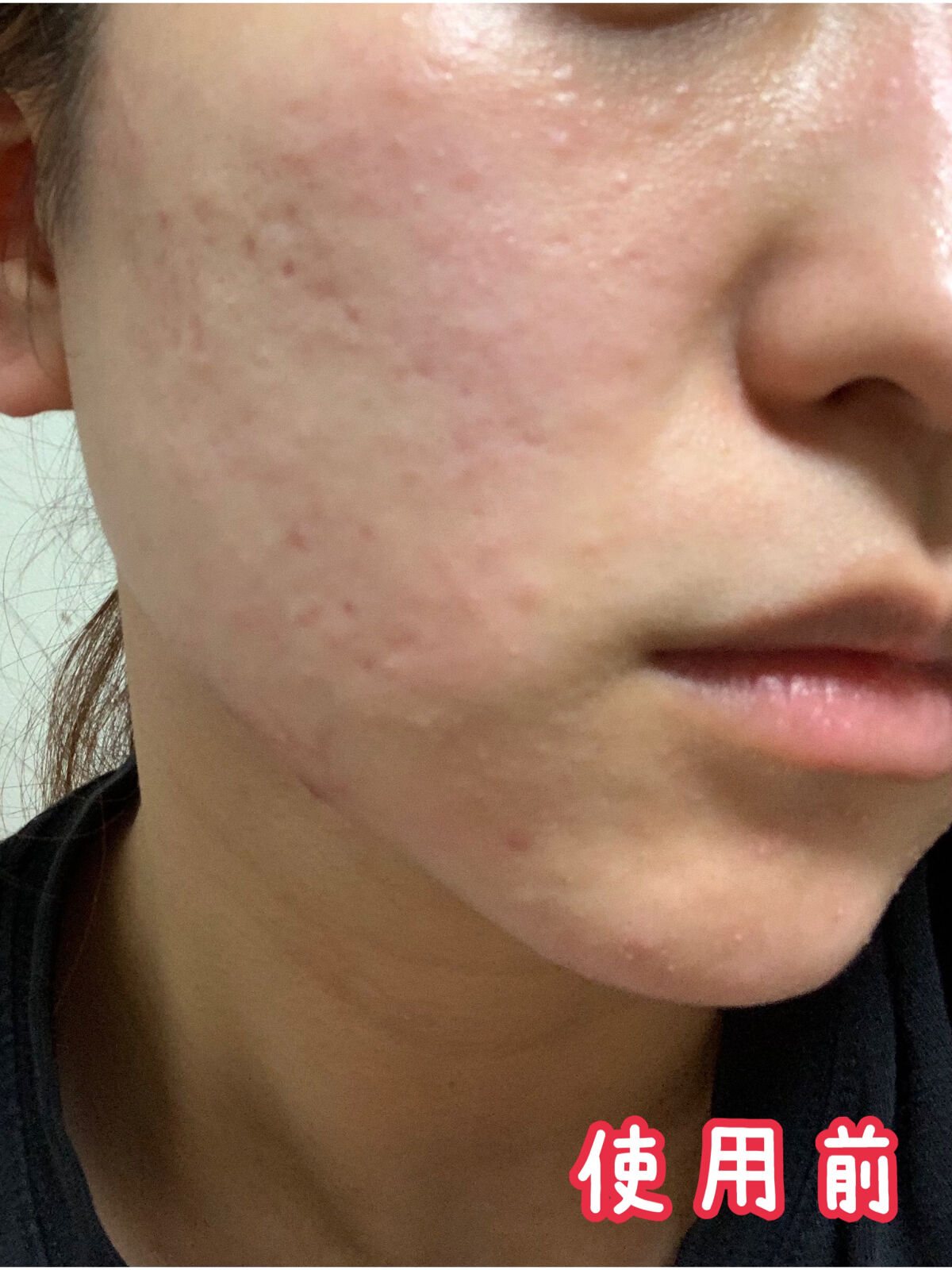 モイスチュア ローション/カルテHD/化粧水を使ったクチコミ（3枚目）