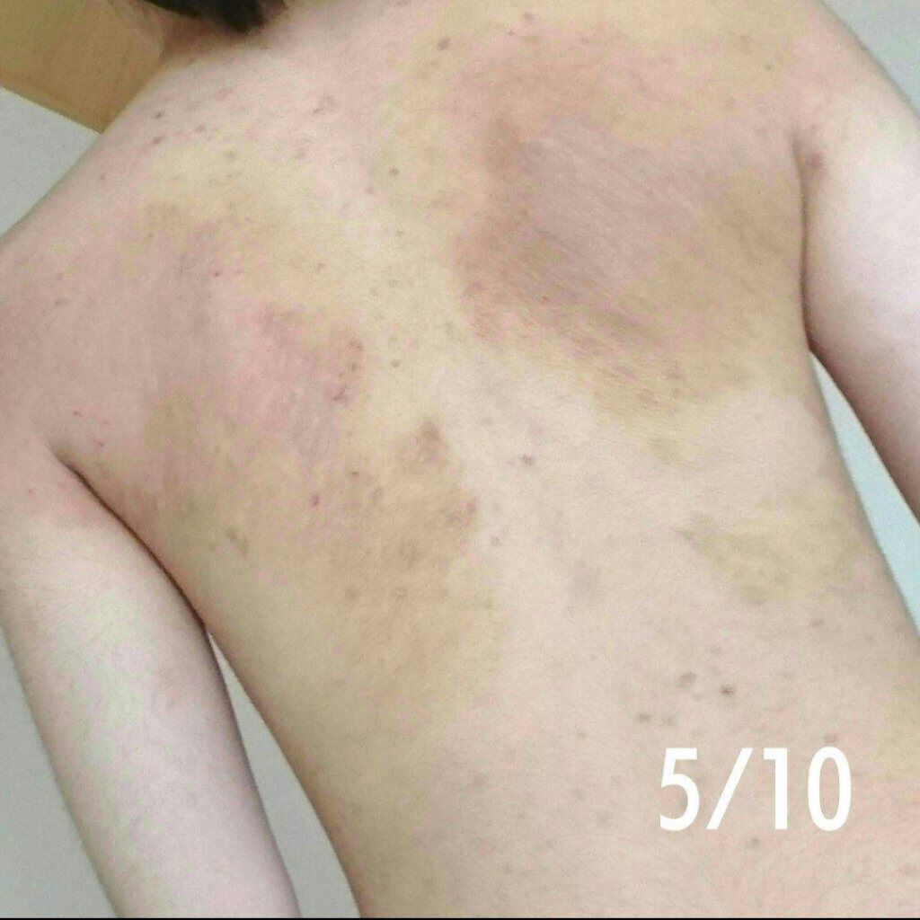 メンタームEXプラスクリーム(医薬品)/メンターム/その他を使ったクチコミ(3枚目)