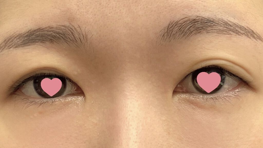 二重整形/その他を使ったクチコミ（1枚目）