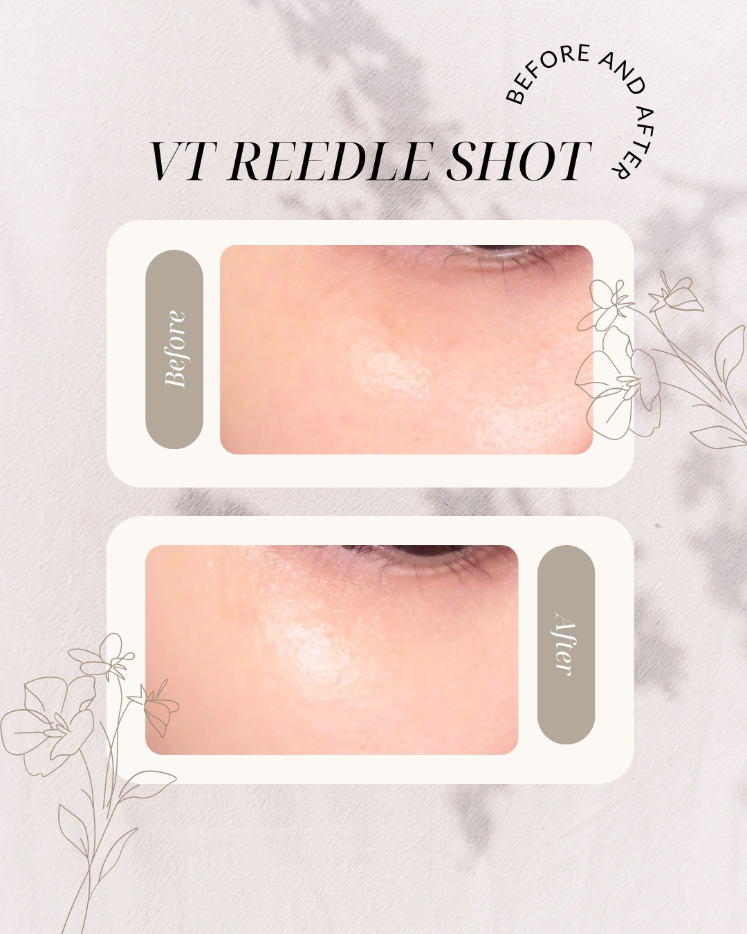 リードルショット300/VT/美容液を使ったクチコミ（1枚目）