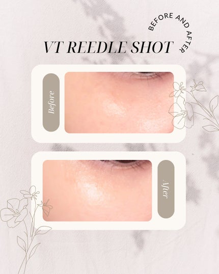 リードルショット300/VT/美容液を使ったクチコミ(1枚目)