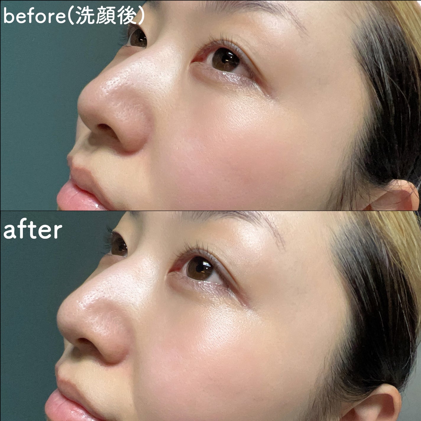 ピンクティーツリーシナジーセラム/APLIN/美容液を使ったクチコミ(6枚目)