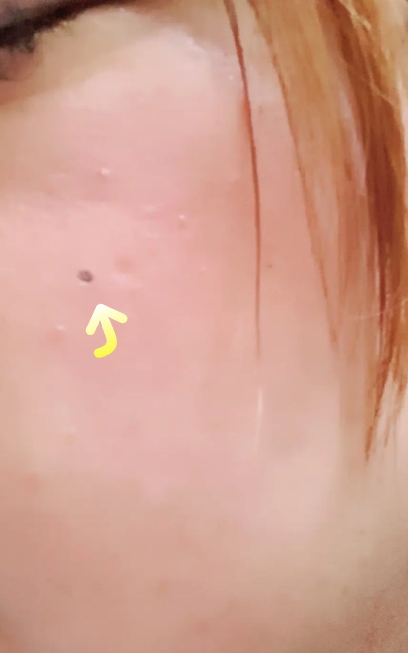 リサ・ラーソン♡クッションファンデマニア on LIPS 「#皮膚科#レーザー治療#ホクロ除去..」(2枚目)