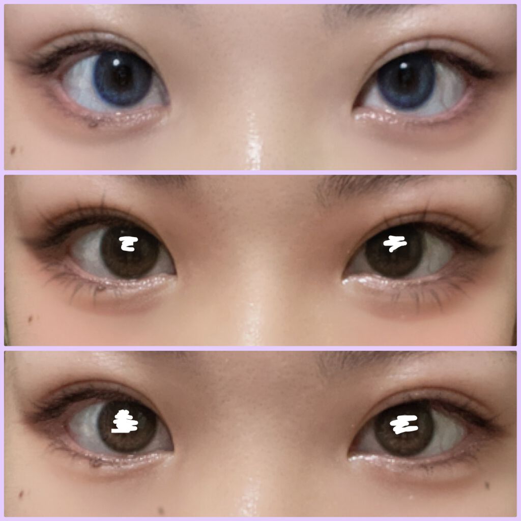 二重整形/その他を使ったクチコミ（2枚目）