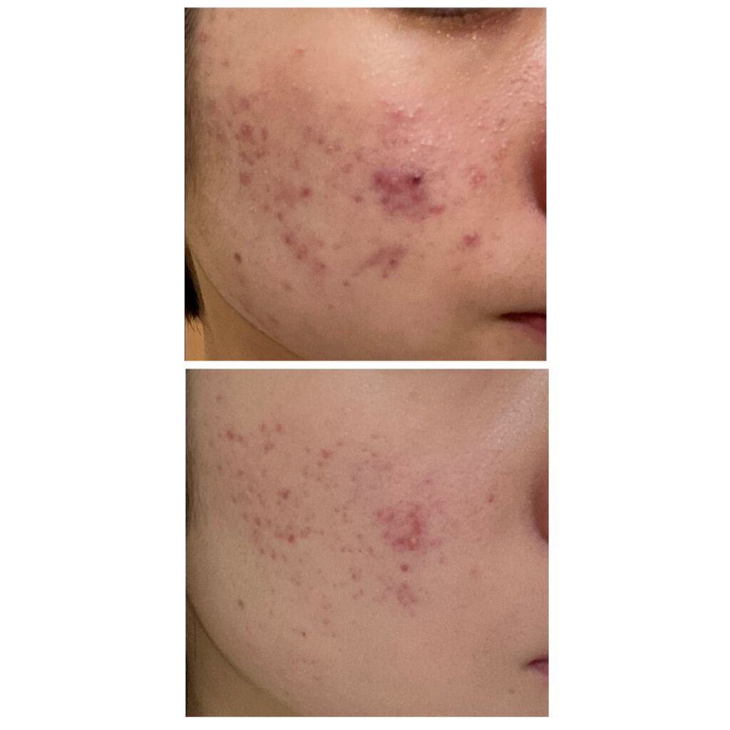 クリンダマイシンゲル(医薬品)/クラシエ薬品/その他を使ったクチコミ（2枚目）