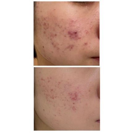 クリンダマイシンゲル(医薬品)/クラシエ薬品/その他を使ったクチコミ(2枚目)