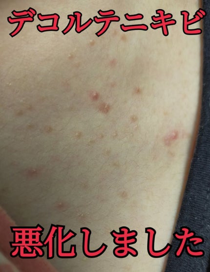 ニキビを防ぐ薬用石鹸 ForBack/ペリカン石鹸/ボディ石鹸を使ったクチコミ(1枚目)